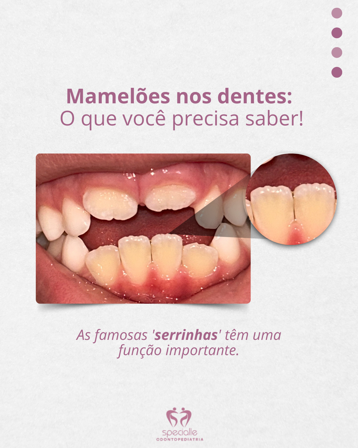 SERRINHAS NOS DENTES PERMANENTES?